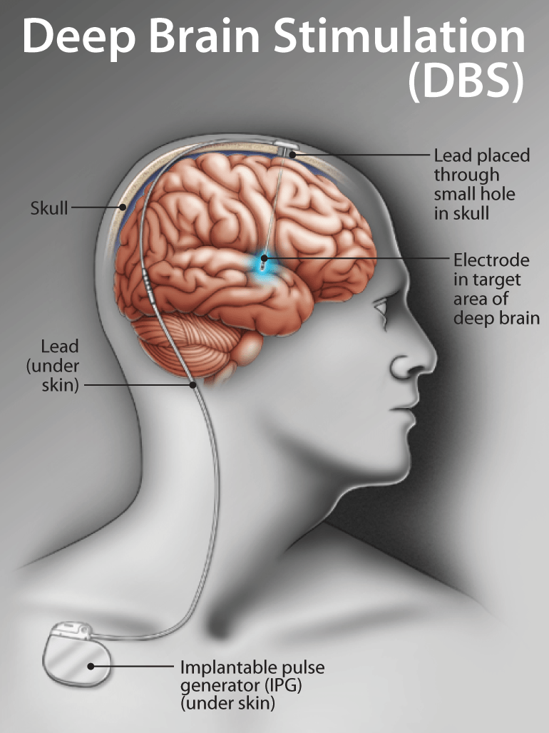 Deep Brain Stimulation - The Defeating Epilepsy Foundation