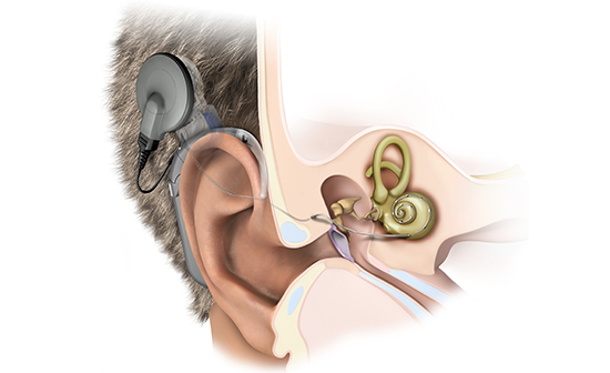 Кохлеарная имплантация. Имплантируемые слуховые системы компании Cochlear